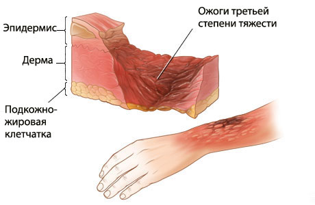 Ожоги виды симптомы первая медицинская помощь